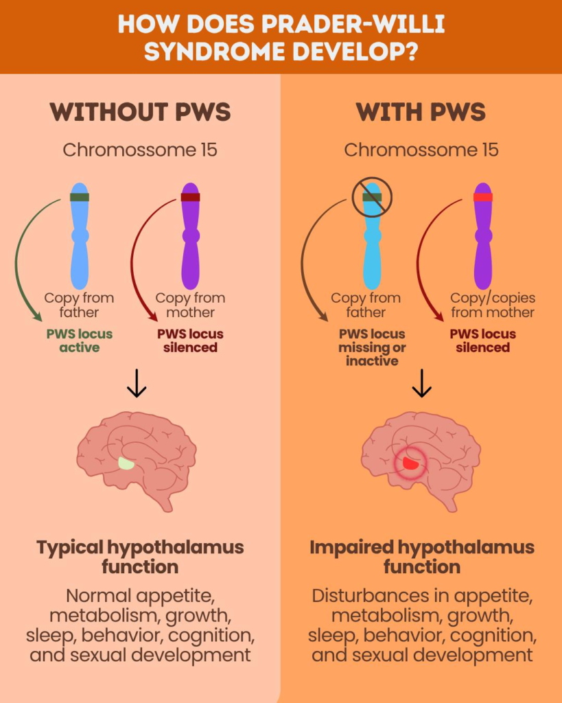 Prader-Willi syndrome is a genetic condition linked to changes in chromosome 15. It can affect hunger, growth, metabolism, sleep, and development.